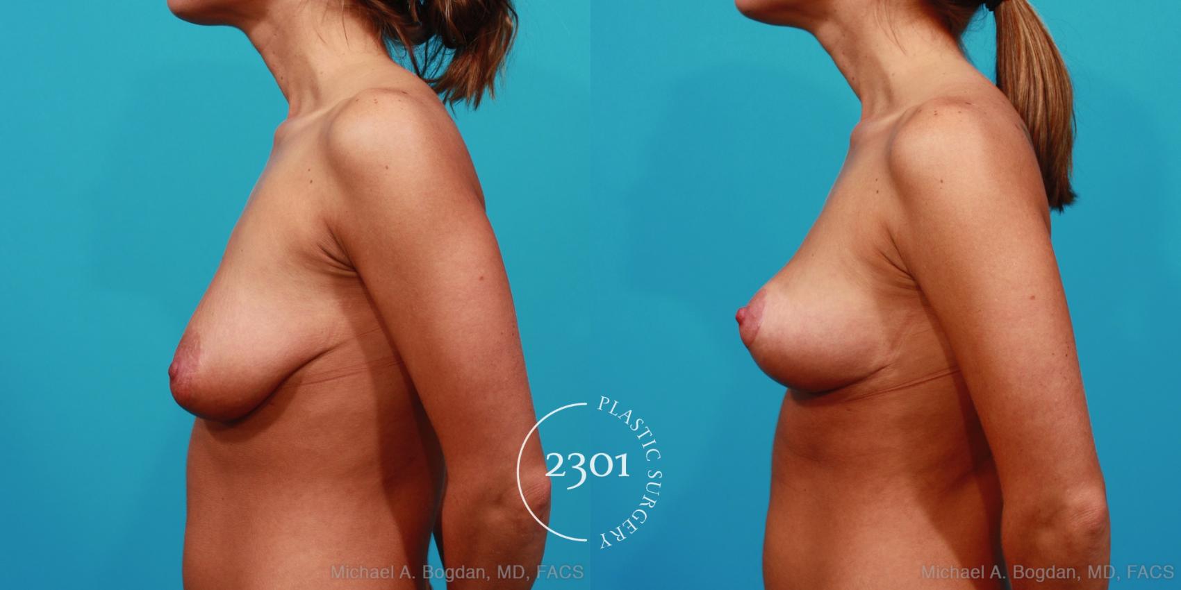 Before & After Mastopexy & Augmentation Case 241 View #5 View in Fort Worth, Plano, & Frisco, Texas