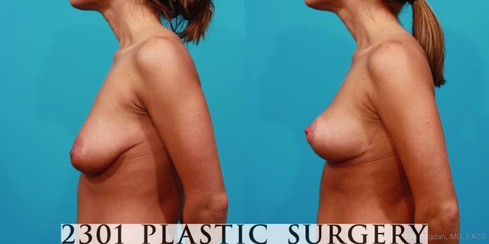Before & After Mastopexy & Augmentation Case 241 View #5 View in Fort Worth, Plano, & Frisco, Texas