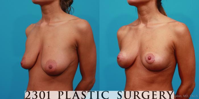 Before & After Mastopexy & Augmentation Case 241 View #6 View in Fort Worth, Plano, & Frisco, Texas