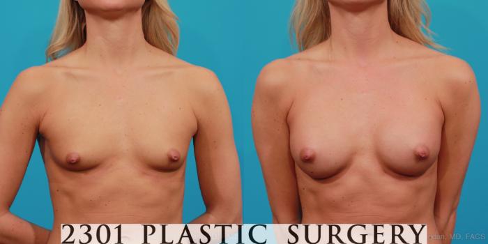 Before & After Breast Augmentation Case 330 View #1 View in Fort Worth, Plano, & Frisco, Texas