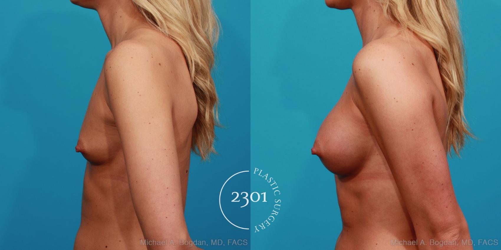 Before & After Breast Augmentation Case 330 View #2 View in Fort Worth, Plano, & Frisco, Texas