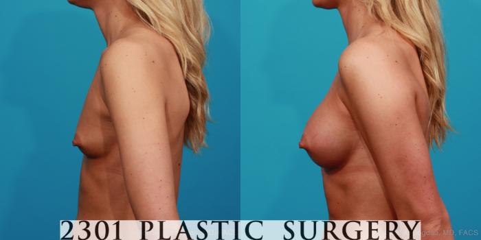 Before & After Breast Augmentation Case 330 View #2 View in Fort Worth, Plano, & Frisco, Texas