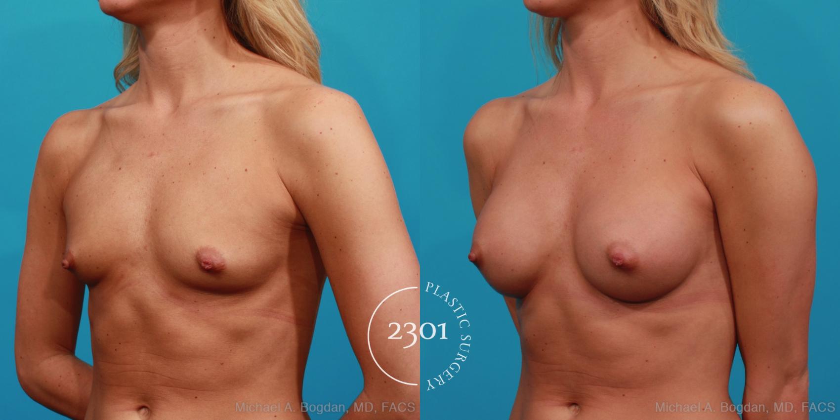 Before & After Breast Augmentation Case 330 View #3 View in Fort Worth, Plano, & Frisco, Texas
