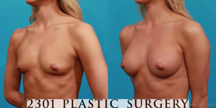 Before & After Breast Augmentation Case 330 View #3 View in Fort Worth, Plano, & Frisco, Texas