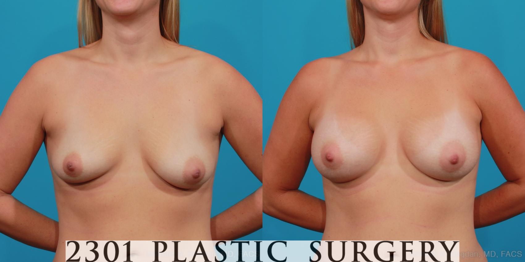 Before & After Breast Augmentation Case 333 View #1 View in Fort Worth, Plano, & Frisco, Texas