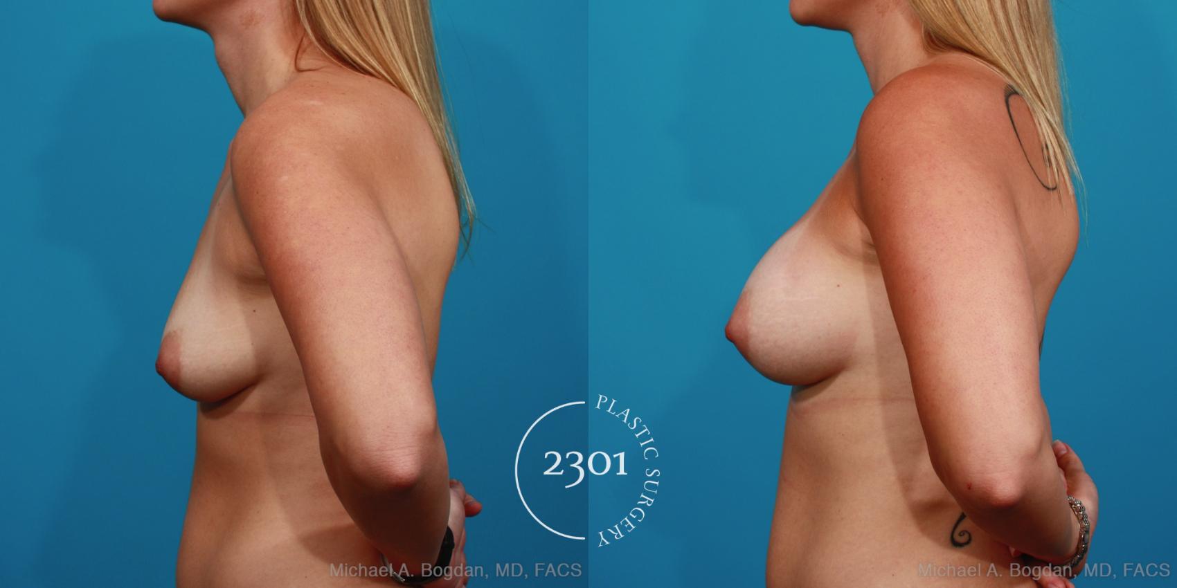 Before & After Breast Augmentation Case 333 View #2 View in Fort Worth, Plano, & Frisco, Texas