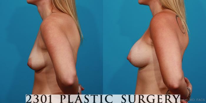 Before & After Breast Augmentation Case 333 View #2 View in Fort Worth, Plano, & Frisco, Texas