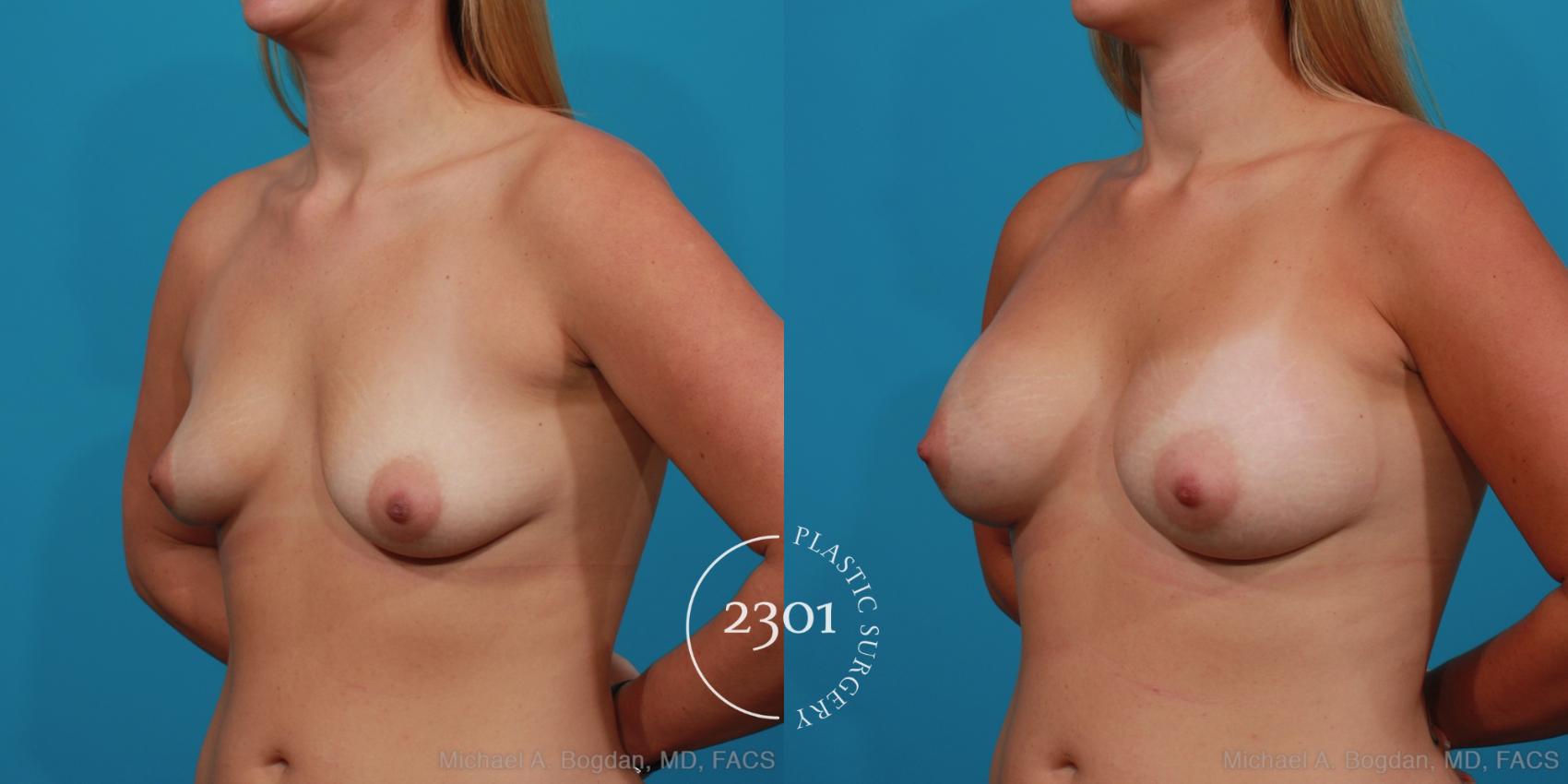 Before & After Breast Augmentation Case 333 View #3 View in Fort Worth, Plano, & Frisco, Texas