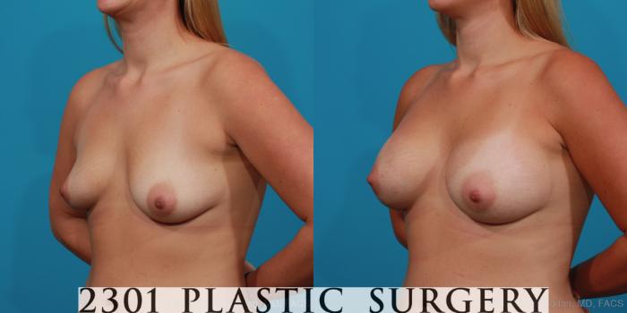 Before & After Breast Augmentation Case 333 View #3 View in Fort Worth, Plano, & Frisco, Texas