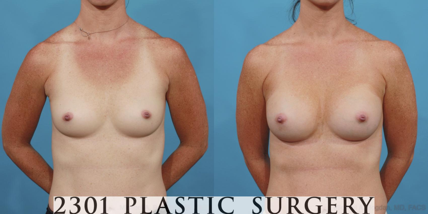 Before & After Silicone Implants Case 569 View #1 View in Fort Worth, Plano, & Frisco, Texas