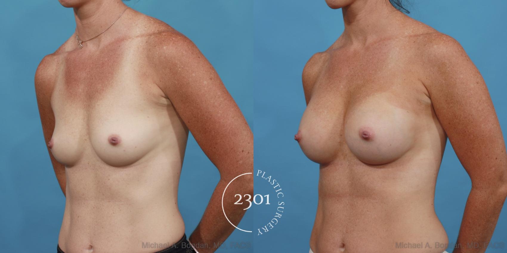 Before & After Silicone Implants Case 569 View #2 View in Fort Worth, Plano, & Frisco, Texas