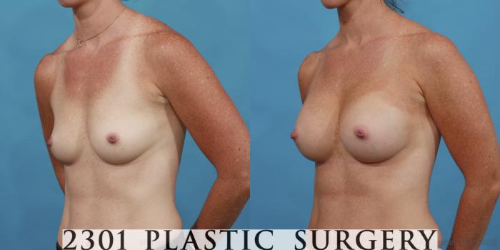 Before & After Breast Augmentation Case 569 View #2 View in Fort Worth, Plano, & Frisco, Texas