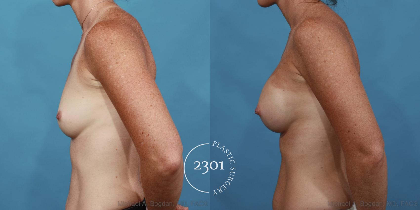 Before & After Silicone Implants Case 569 View #3 View in Fort Worth, Plano, & Frisco, Texas