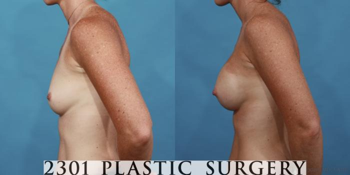 Before & After Silicone Implants Case 569 View #3 View in Fort Worth, Plano, & Frisco, Texas