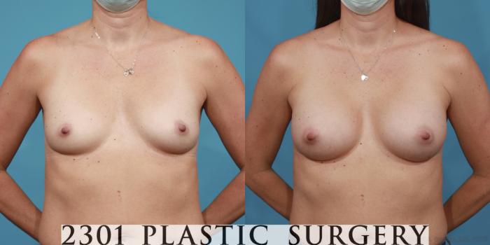 Before & After Silicone Implants Case 611 Front View in Fort Worth, Plano, & Frisco, Texas