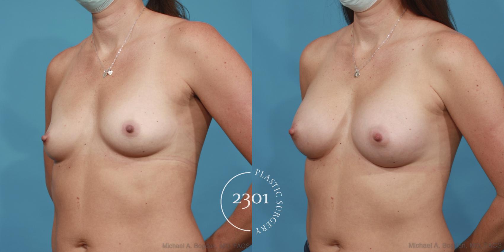 Before & After Silicone Implants Case 611 Left Oblique View in Fort Worth, Plano, & Frisco, Texas