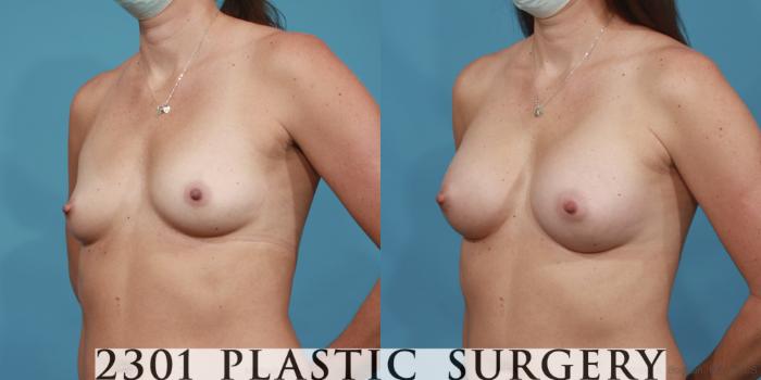 Before & After Breast Augmentation Case 611 Left Oblique View in Fort Worth, Plano, & Frisco, Texas