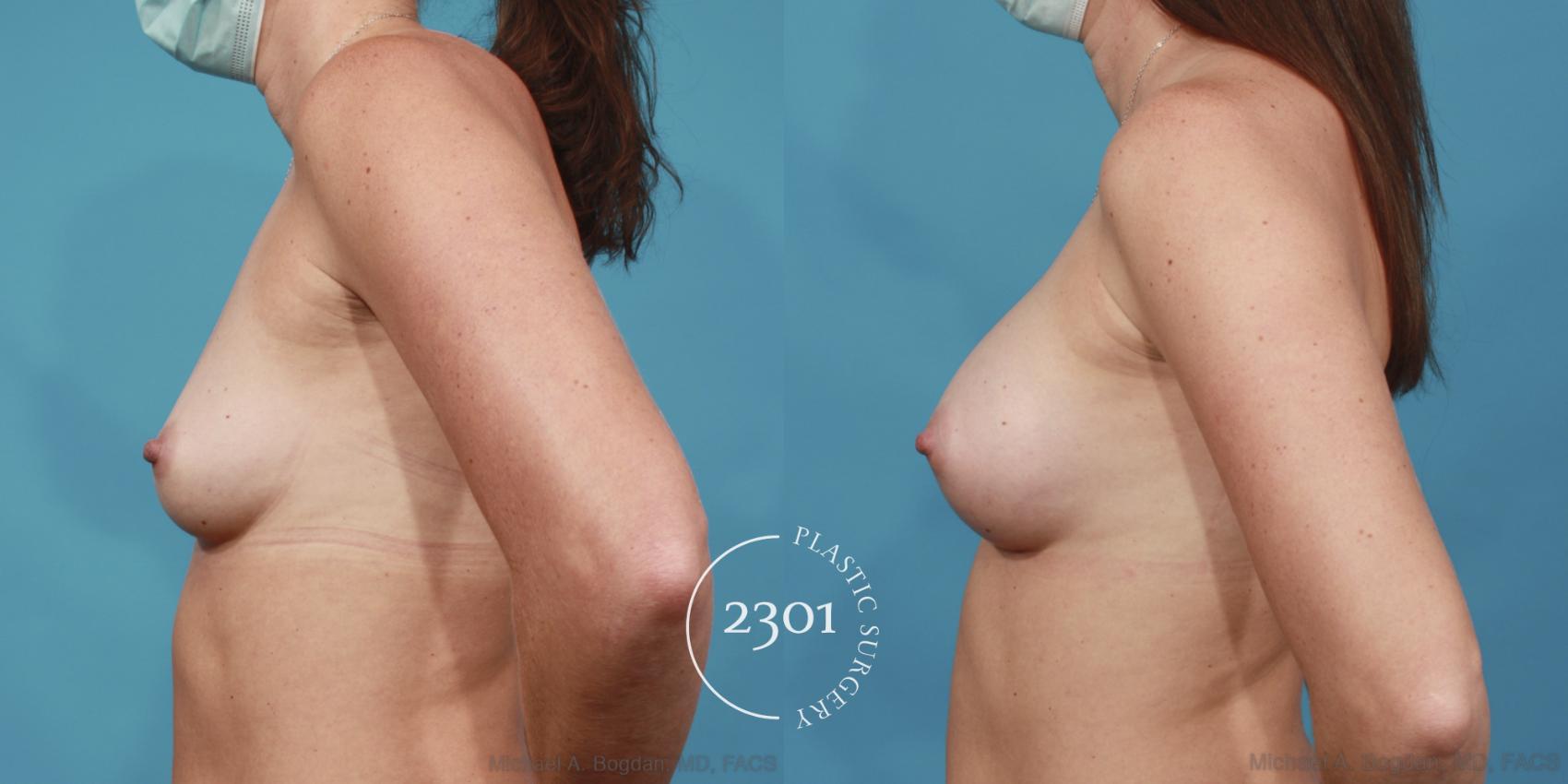 Before & After Silicone Implants Case 611 Left Side View in Fort Worth, Plano, & Frisco, Texas