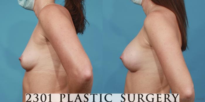 Before & After Breast Augmentation Case 611 Left Side View in Fort Worth, Plano, & Frisco, Texas