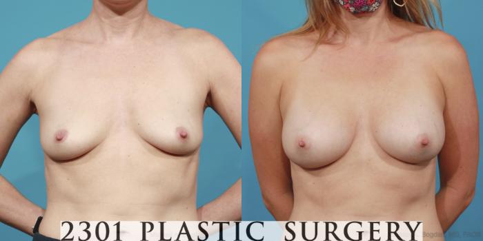 Before & After Breast Augmentation Case 612 Front View in Fort Worth, Plano, & Frisco, Texas