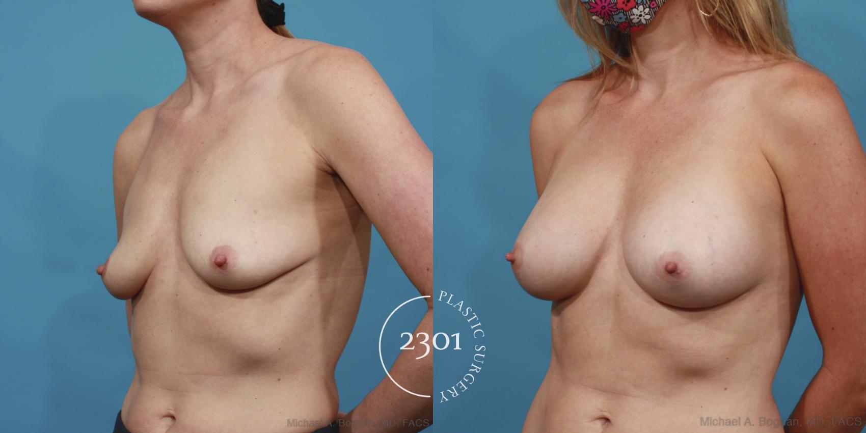 Before & After Silicone Implants Case 612 Left Oblique View in Fort Worth, Plano, & Frisco, Texas