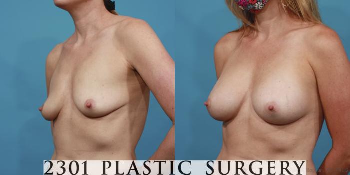 Before & After Breast Augmentation Case 612 Left Oblique View in Fort Worth, Plano, & Frisco, Texas