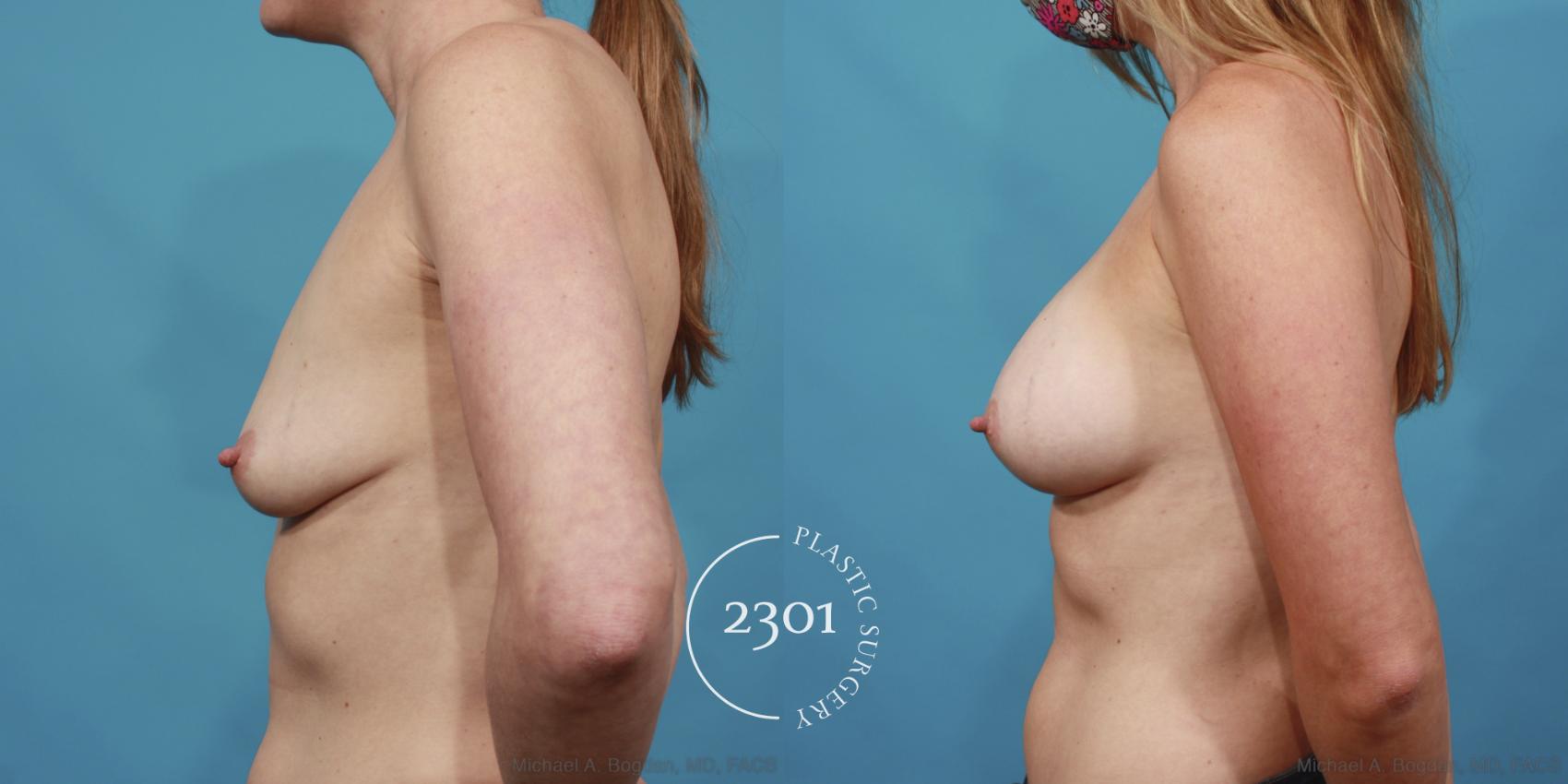 Before & After Silicone Implants Case 612 Left Side View in Fort Worth, Plano, & Frisco, Texas
