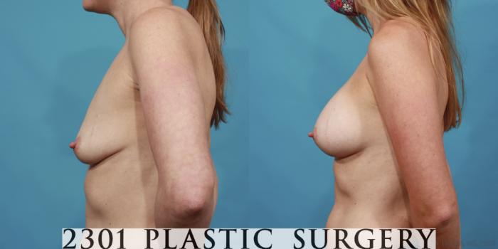 Before & After Breast Augmentation Case 612 Left Side View in Fort Worth, Plano, & Frisco, Texas