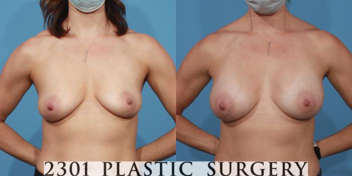 Before & After Breast Augmentation Case 613 Front View in Fort Worth, Plano, & Frisco, Texas