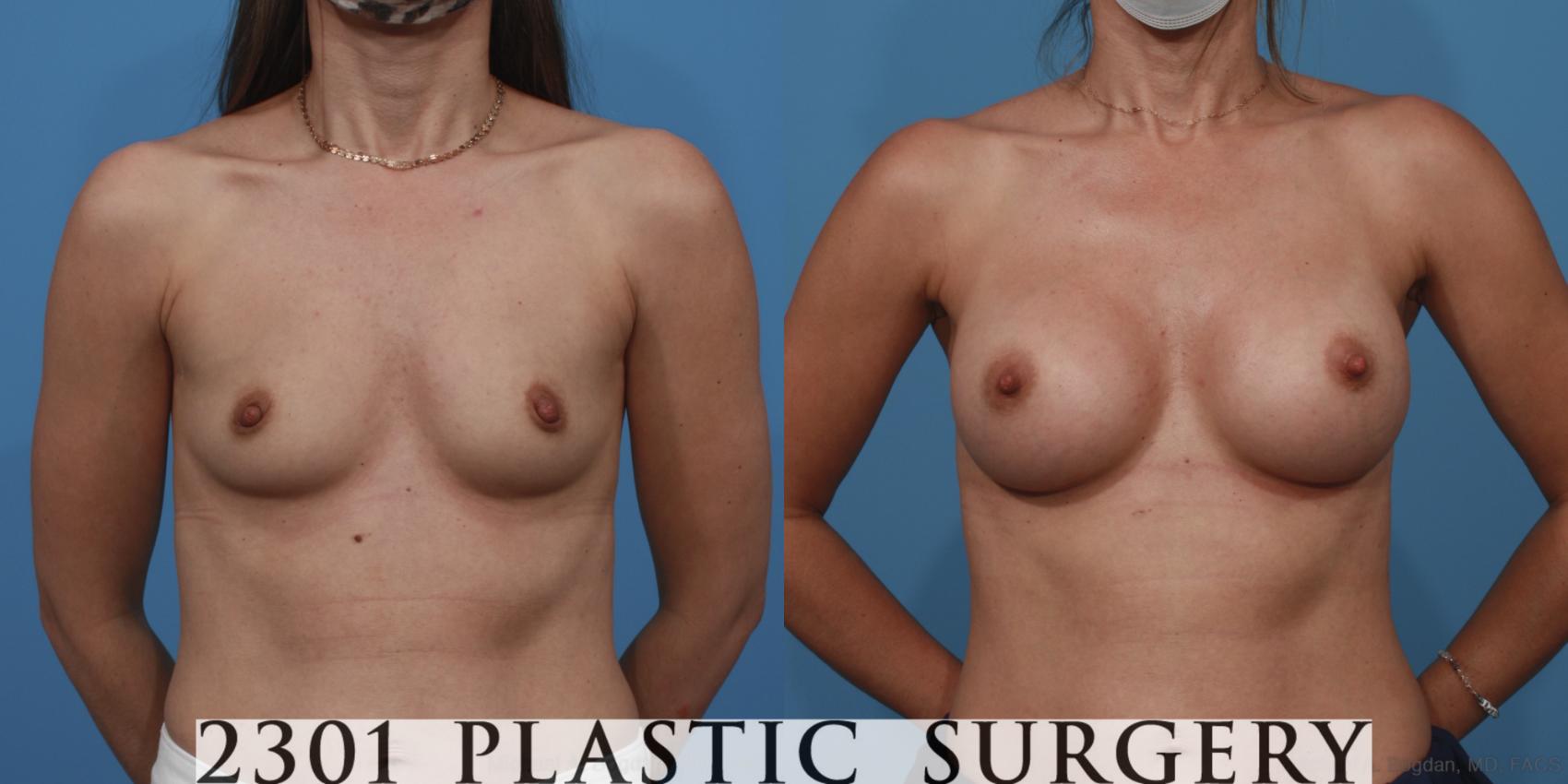 Before & After Breast Augmentation Case 614 Front View in Fort Worth & Frisco, Texas