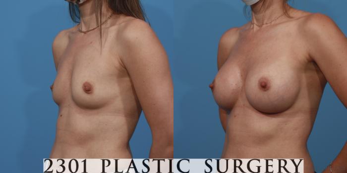 Before & After Breast Augmentation Case 614 Left Oblique View in Fort Worth, Plano, & Frisco, Texas