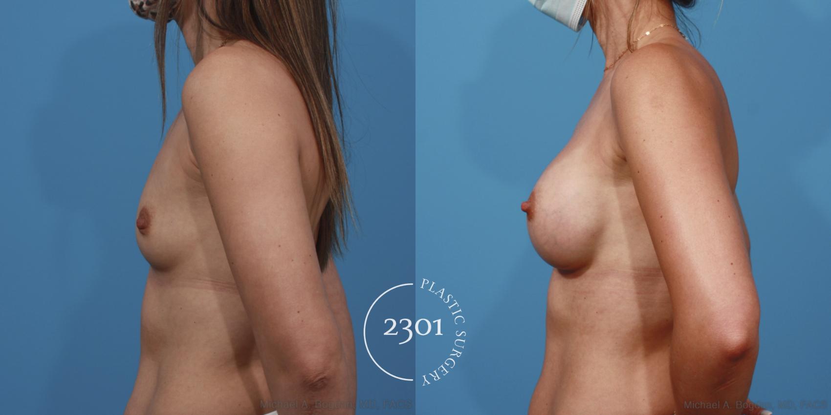 Before & After Silicone Implants Case 614 Left Side View in Fort Worth, Plano, & Frisco, Texas