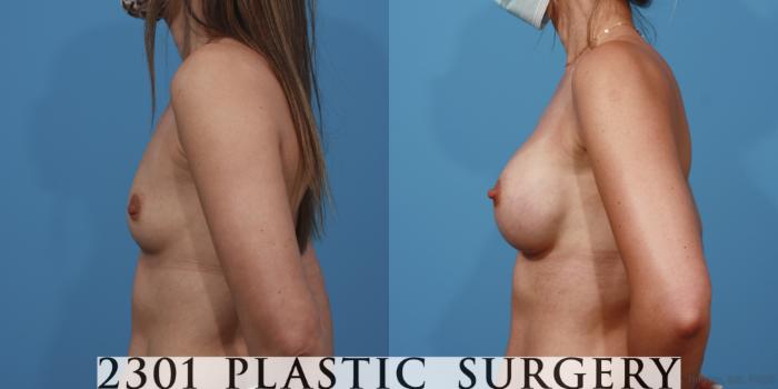 Before & After Silicone Implants Case 614 Left Side View in Fort Worth, Plano, & Frisco, Texas