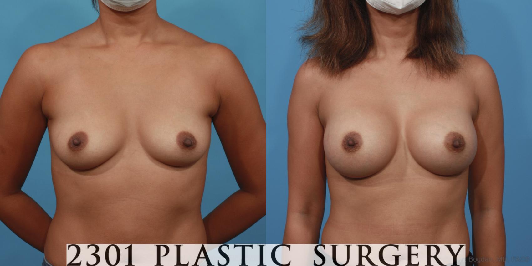 Before & After Silicone Implants Case 615 Front View in Fort Worth, Plano, & Frisco, Texas