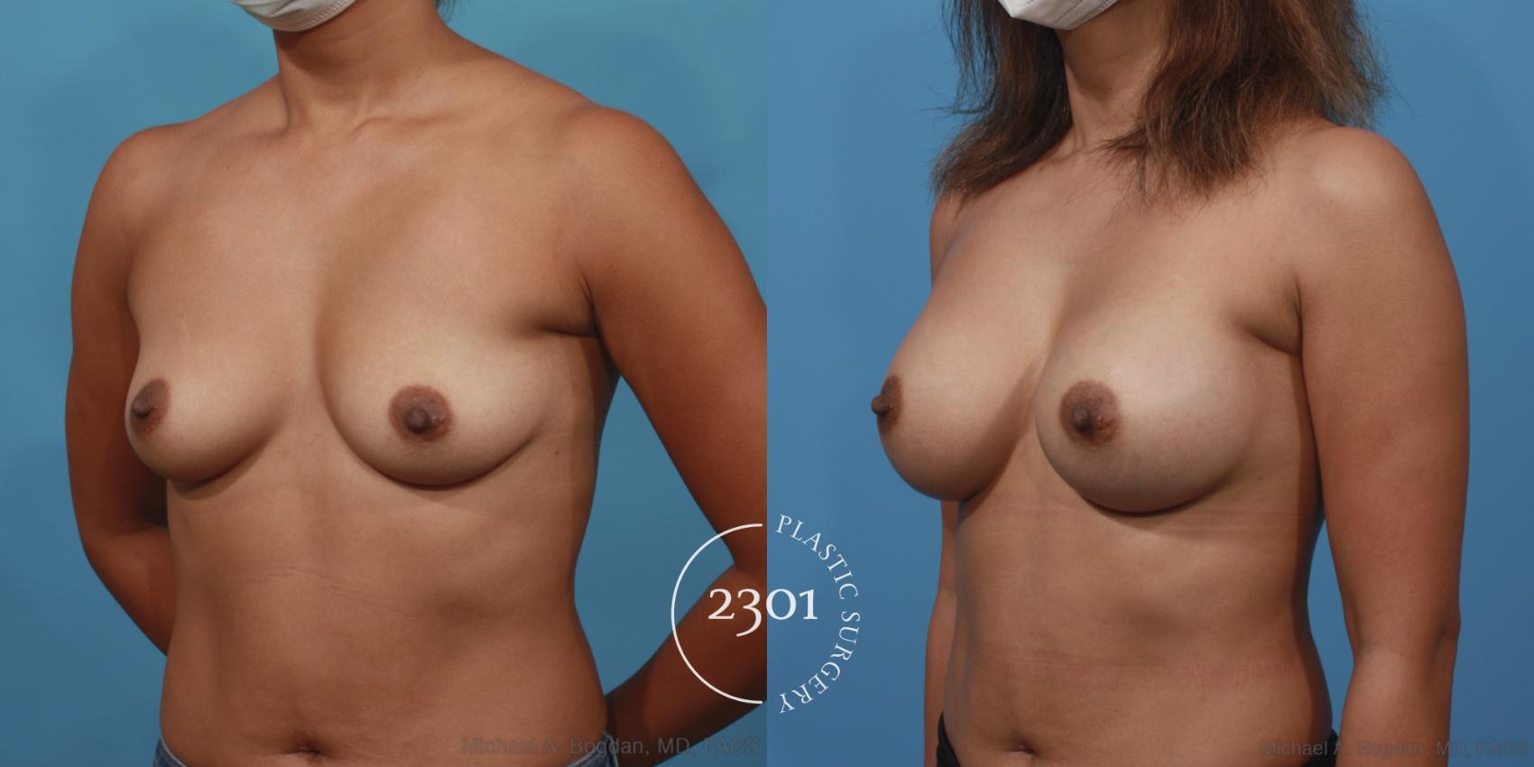 Before & After Silicone Implants Case 615 Left Oblique View in Fort Worth, Plano, & Frisco, Texas