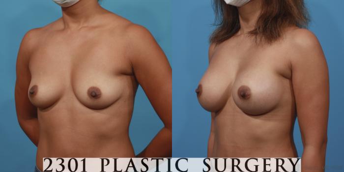 Before & After Breast Augmentation Case 615 Left Oblique View in Fort Worth, Plano, & Frisco, Texas