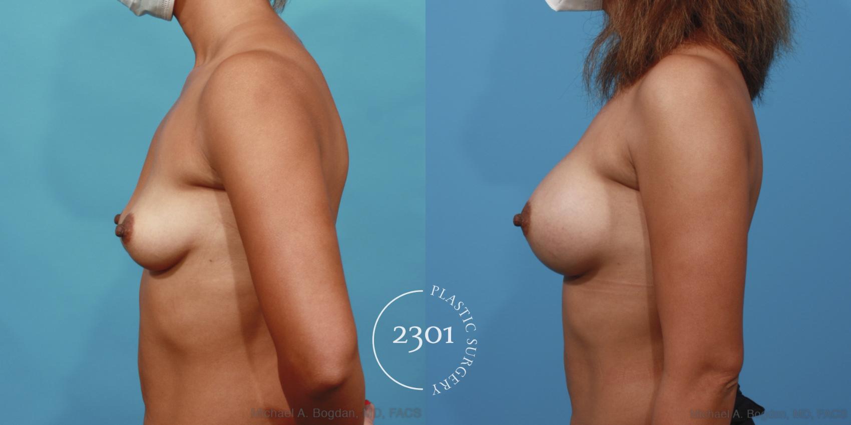 Before & After Silicone Implants Case 615 Left Side View in Fort Worth, Plano, & Frisco, Texas