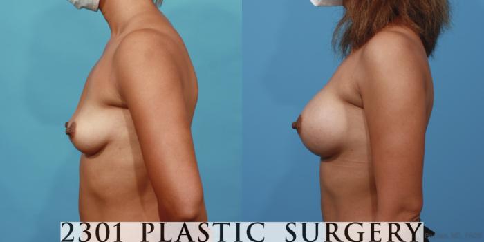 Before & After Silicone Implants Case 615 Left Side View in Fort Worth, Plano, & Frisco, Texas
