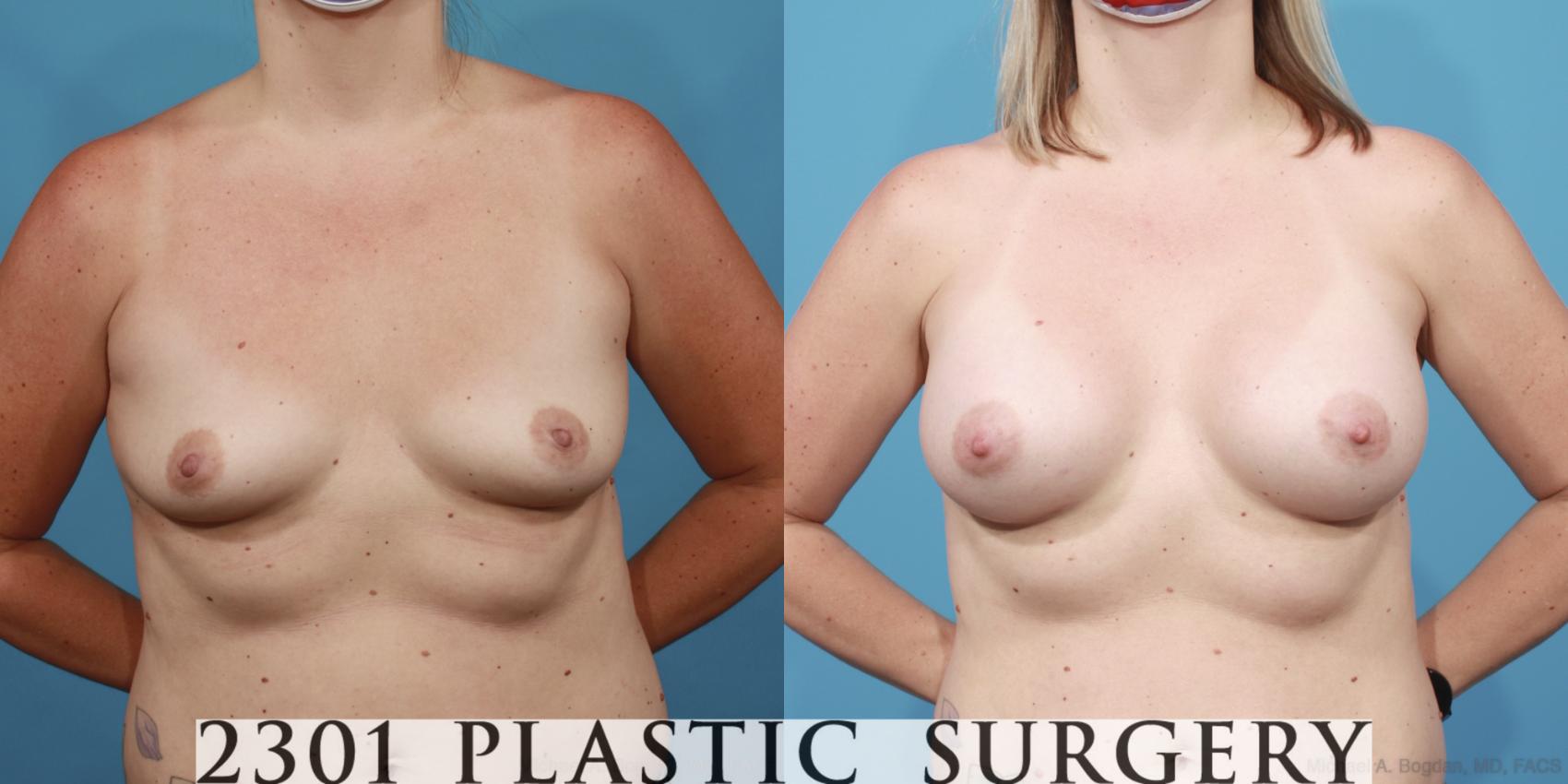 Before & After Breast Augmentation Case 616 Front View in Fort Worth, Plano, & Frisco, Texas