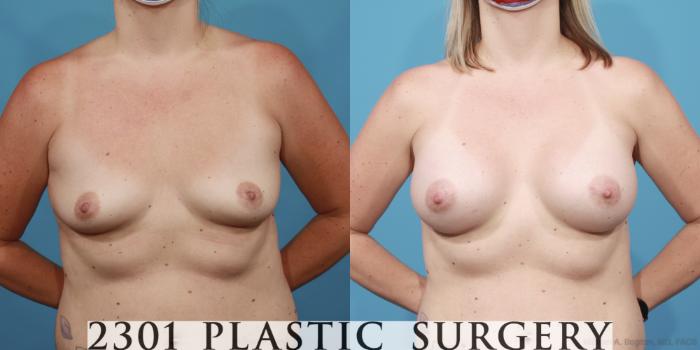 Before & After Breast Augmentation Case 616 Front View in Fort Worth, Plano, & Frisco, Texas