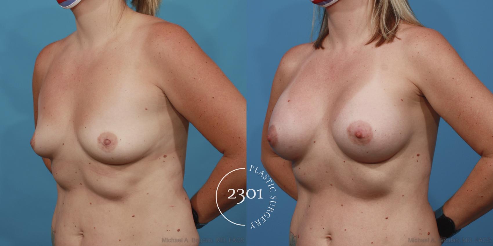 Before & After Silicone Implants Case 616 Left Oblique View in Fort Worth, Plano, & Frisco, Texas