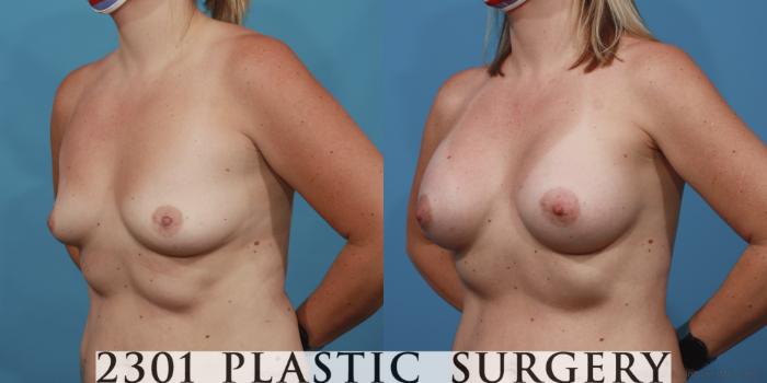 Before & After Breast Augmentation Case 616 Left Oblique View in Fort Worth, Plano, & Frisco, Texas