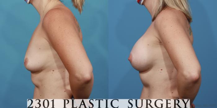 Before & After Breast Augmentation Case 616 Left Side View in Fort Worth, Plano, & Frisco, Texas