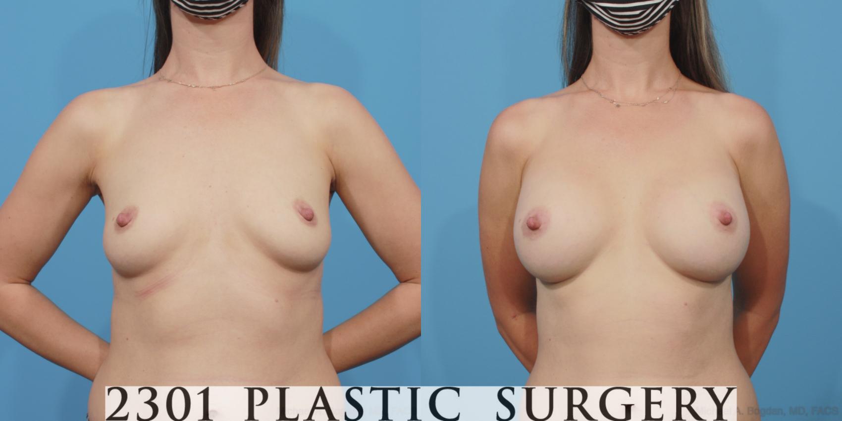 Before & After Silicone Implants Case 617 Front View in Fort Worth, Plano, & Frisco, Texas