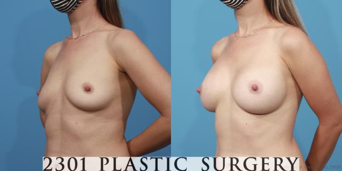 Before & After Breast Augmentation Case 617 Left Oblique View in Fort Worth, Plano, & Frisco, Texas