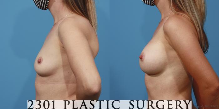 Before & After Breast Augmentation Case 617 Left Side View in Fort Worth, Plano, & Frisco, Texas