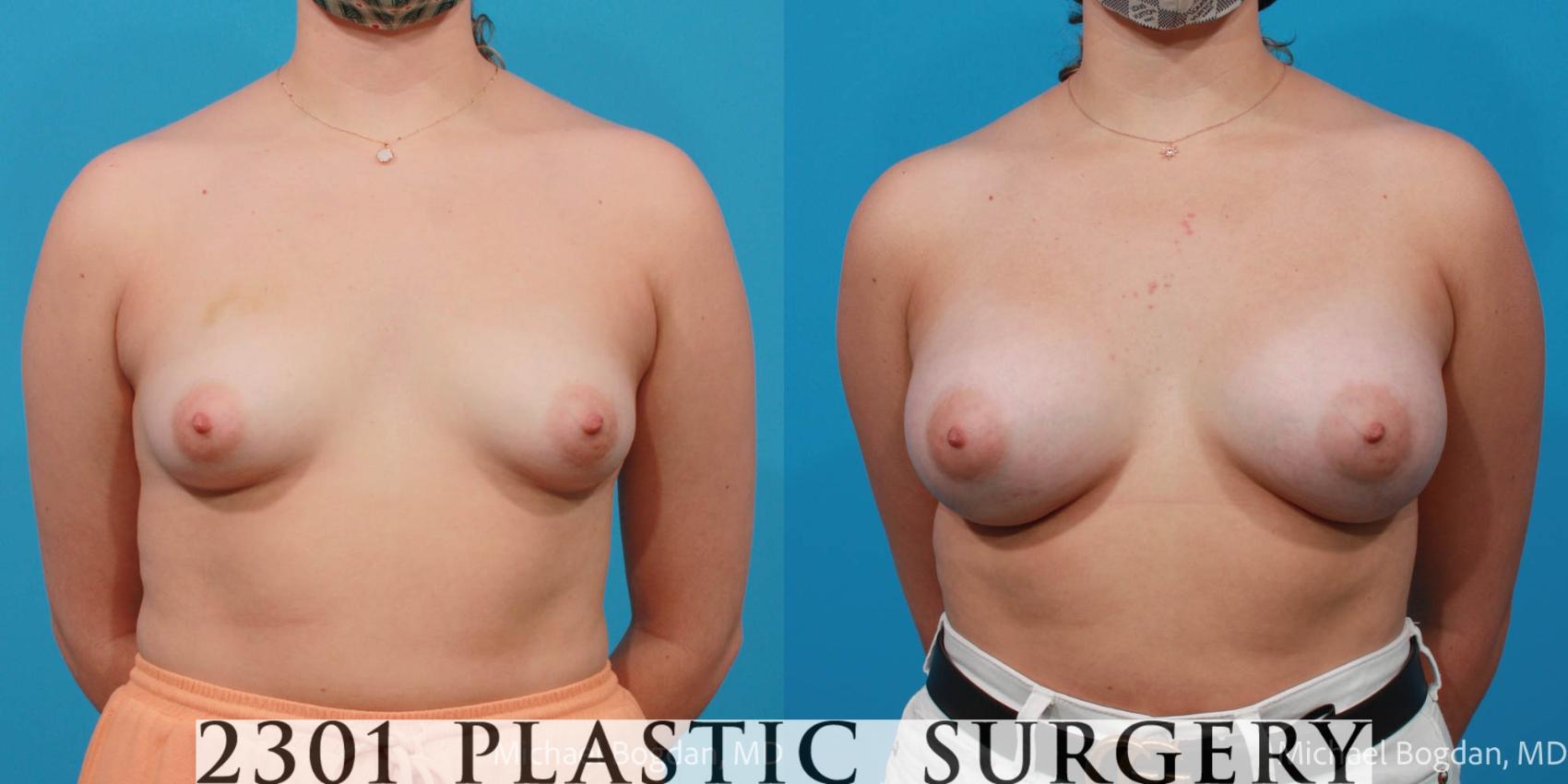 Before & After Breast Augmentation Case 675 Front View in Fort Worth, Plano, & Frisco, Texas