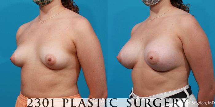Before & After Breast Augmentation Case 675 Left Oblique View in Fort Worth, Plano, & Frisco, Texas