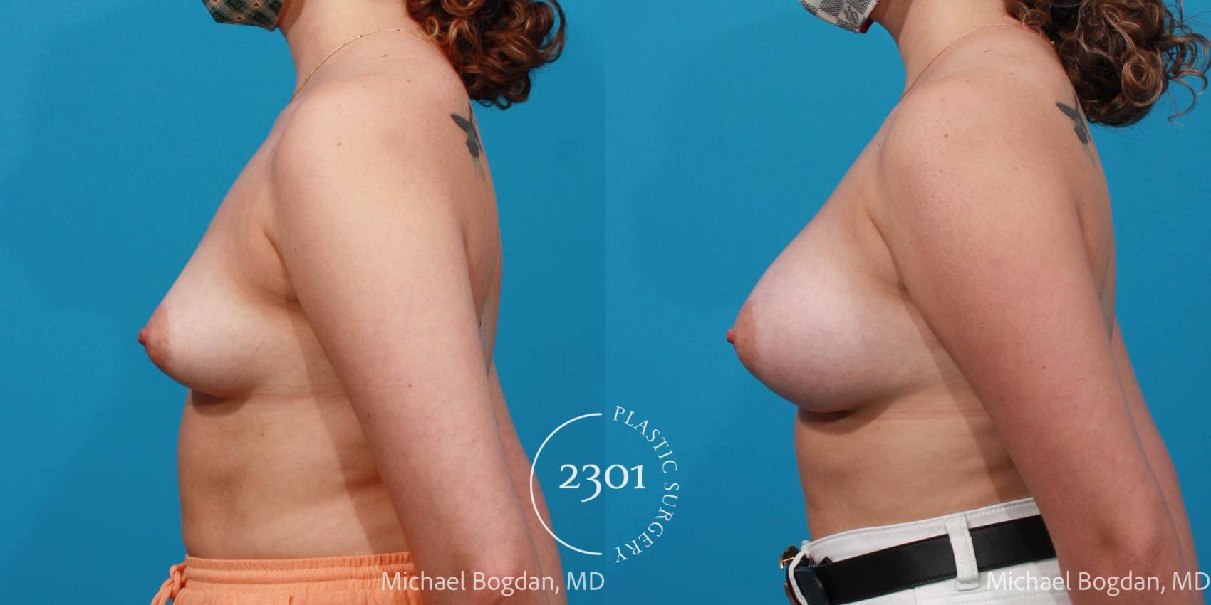 Before & After Breast Augmentation Case 675 Left Side View in Fort Worth, Plano, & Frisco, Texas