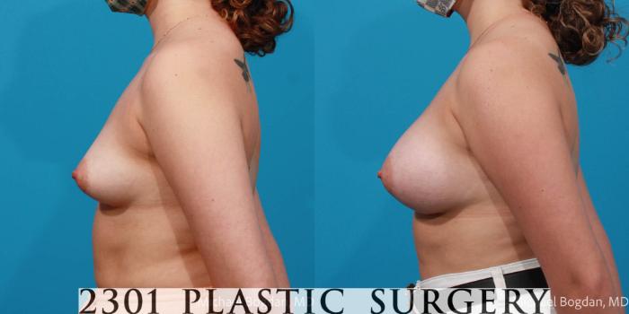 Before & After Breast Augmentation Case 675 Left Side View in Fort Worth, Plano, & Frisco, Texas